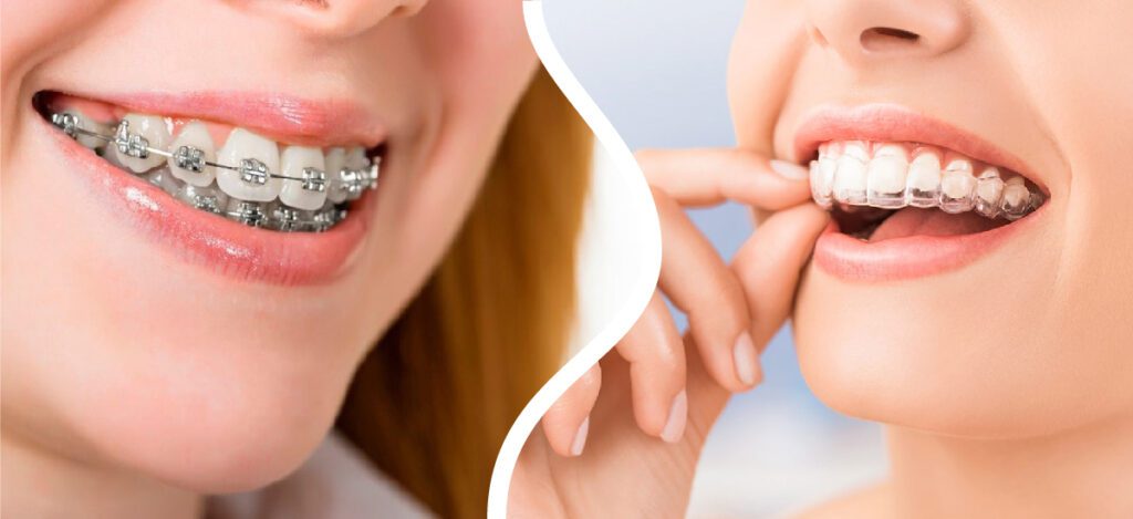 ortodoncia invisible o brackets