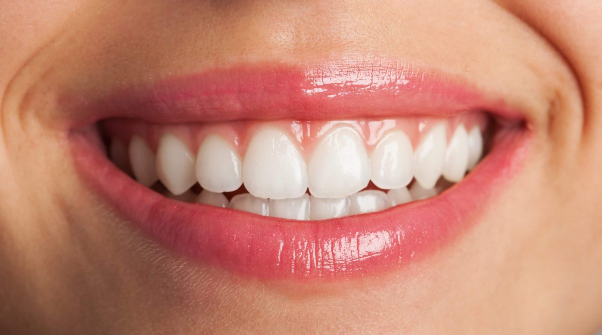 ¿Qué son las manchas blancas en los dientes?